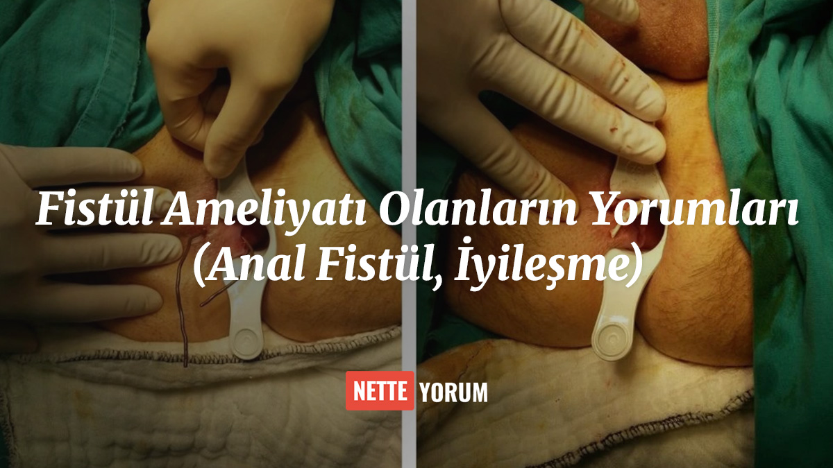 Fistül Ameliyatı Olanların Yorumları (Anal Fistül, İyileşme)